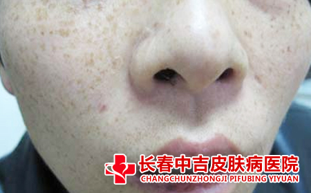  粥治疗雀斑的效果