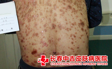  如何护理手足癣