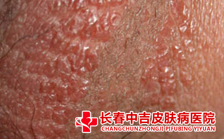 干性湿疹的特征