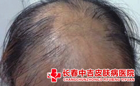  如何积极应对脱发的困扰