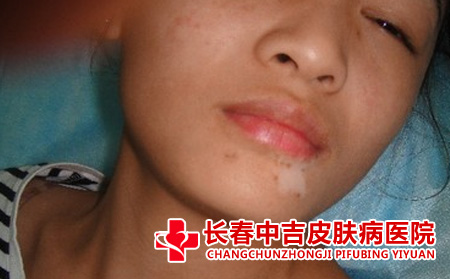   白癜风治疗原则