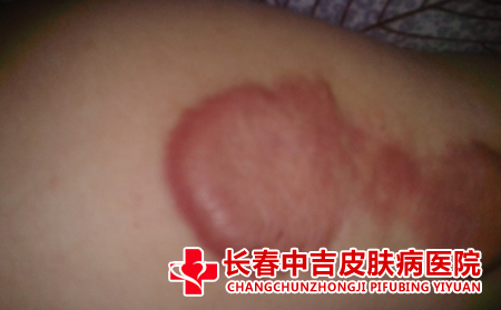 如何判断瘢痕