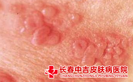 带状疱疹为何会引发头痛