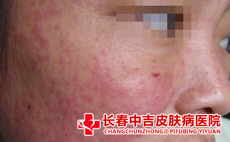 红斑狼疮存活的时间有多长