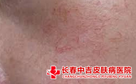 如何对红血丝进行抗敏