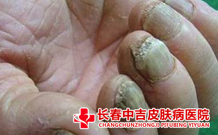 纵横黑甲的症状表现有哪些