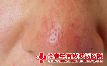 酒槽鼻有哪些症状