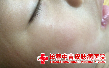  阴道白斑的症状是什么
