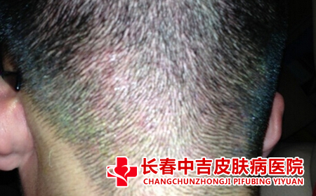 毛囊炎的表现