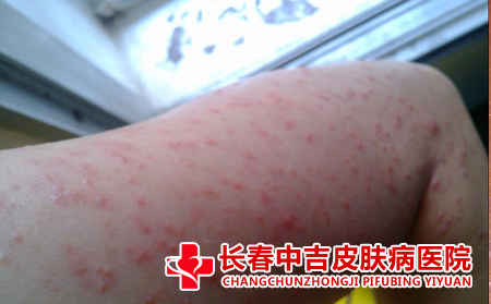 哪些因素诱发神经性皮炎