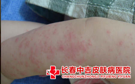  不同部位的湿疹症状