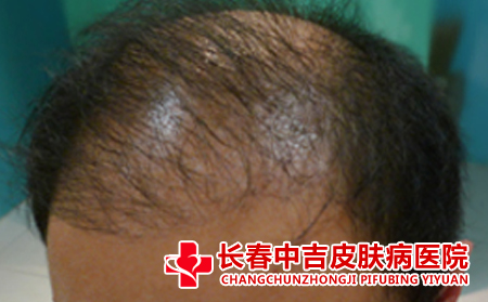 怎么应对脱发的症状