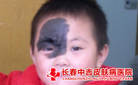  胎记是否遗传