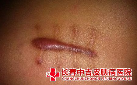 瘢痕增生有哪些特征