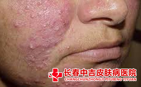 痤疮吃雪糕的不良后果