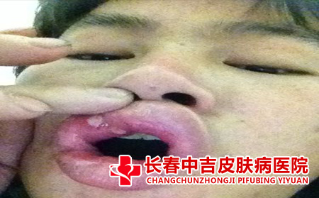 空腔扁平庞治疗的措施有哪些