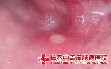 怎样判断儿童疱疹性咽炎