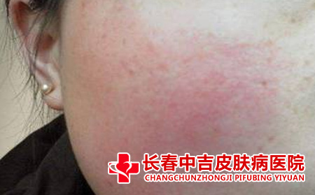  去除红血丝的方式有哪些