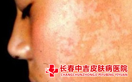 白斑有哪些表现特点