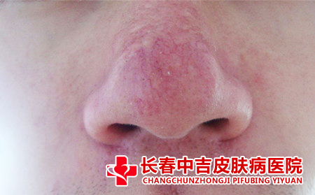 酒槽鼻应该如何治疗