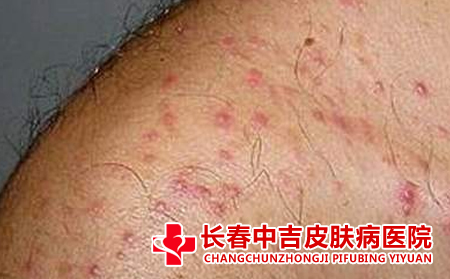 毛囊炎的预防措施