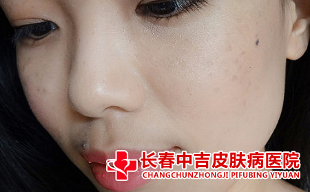 雀斑的诱发因素