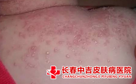 湿疹有哪些表现