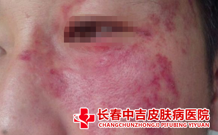  什么因素诱发荨麻疹