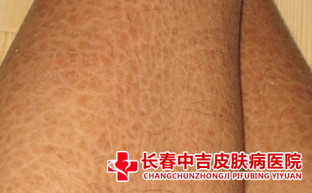  鱼鳞病的症状表现