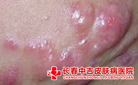 治疗痘痘采用哪些饮食