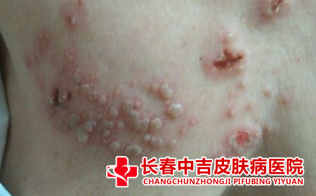 疱疹传染怎么办