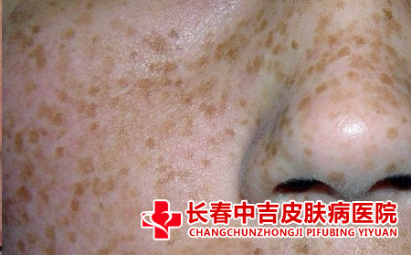 治疗黄褐斑的其他方有哪些