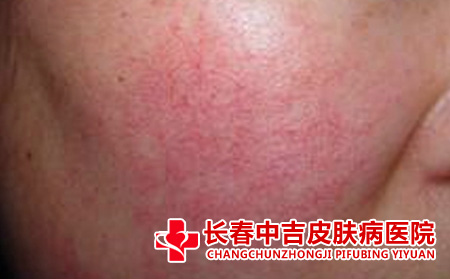  激光治疗红血丝的合适处