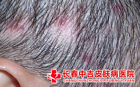 头发毛囊炎的表现形式