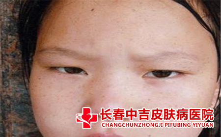儿童雀斑有什么特征
