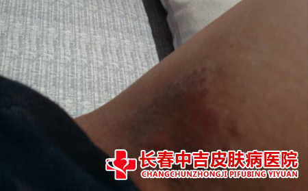  影响股癣的因素