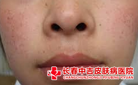  雀斑的治疗误区