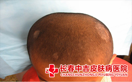头癣如何进行传播的