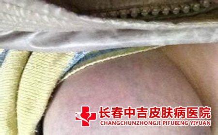 乳房湿疹的表现