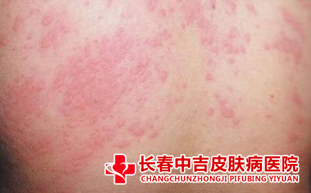 为什么会引起荨麻疹