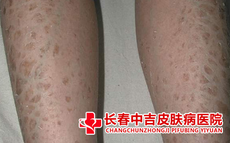   鱼鳞病受到哪些因素