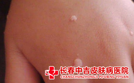 扁平庞如何采用中医疗法