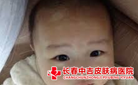  儿童白癜风的表现