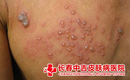 如何正确看待疱疹的症状
