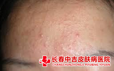 痤疮有哪些症状