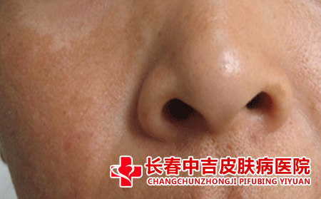 黄褐斑如何去除