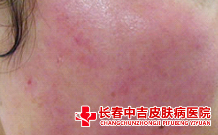  红血丝肤质的去除