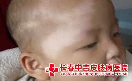白斑如何鉴别