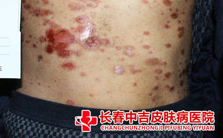 皮肤癣的病症表现是什么