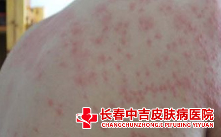 湿疹的护理要素有哪些